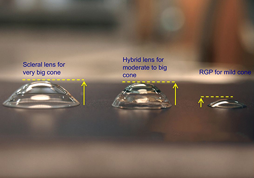 keratoconus.jpg