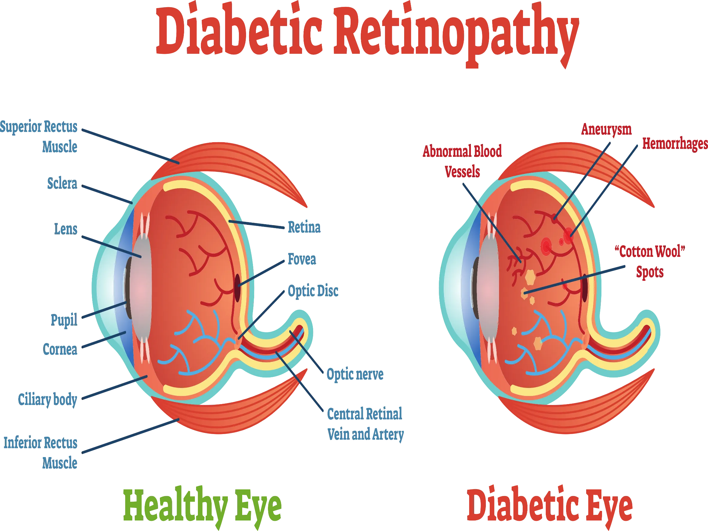 Diabetic Retinopathy