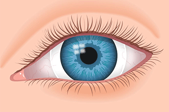 Scleral-Lenses-illustration-330x220